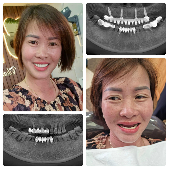 <b>Nguyễn Thị Trang </b>
<span>Phục hình răng mất toàn hàm </span>