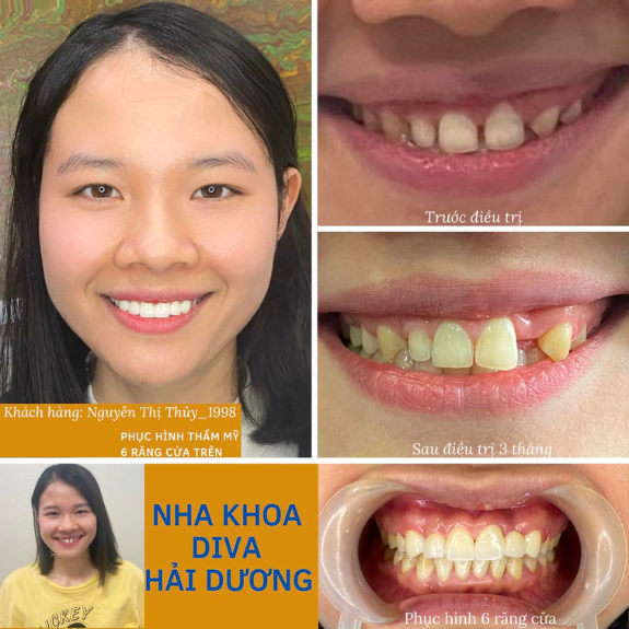 <b>Nguyễn Thị Thủy </b>
<span>Bọc 6 răng Nacera </span>