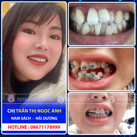 <b>Trần Thị Ngọc Ánh </b>
<span>Niềng răng mắc cài Kim Loại</span>