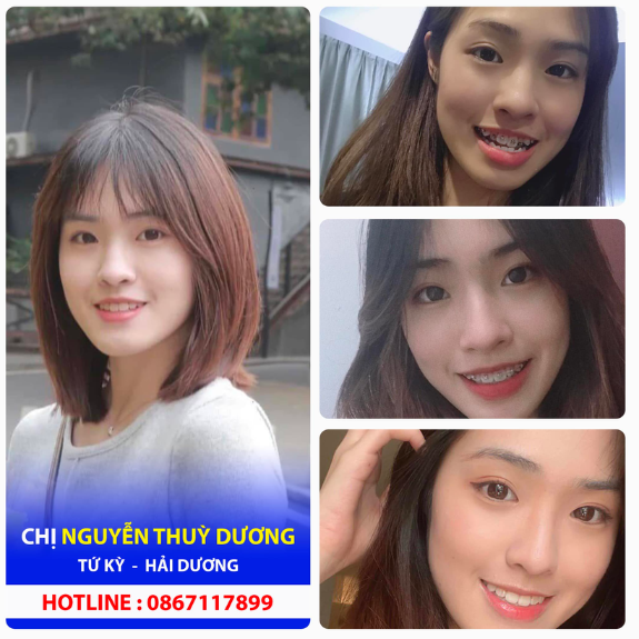 <b>Nguyễn Thùy Dương </b>
<span>Niềng răng mắc cài kim loại </span>