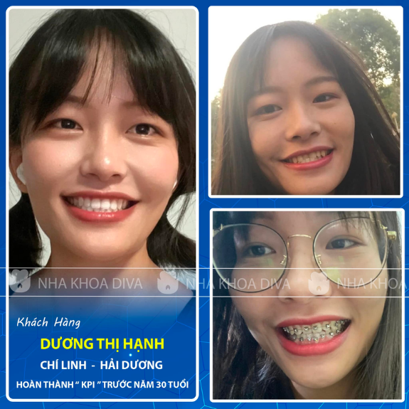 <b>Dương Thị Hạnh </b>
<span>Niềng răng mắc cài Kim Loại </span>