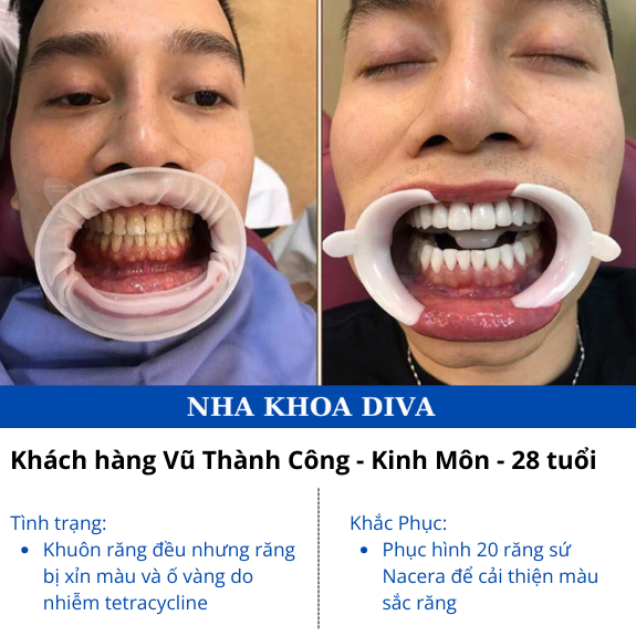 <b>Vũ Thành Công </b>
<span>Bọc 20 răng Nacera </span>