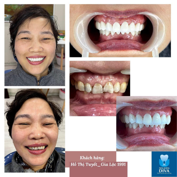 <b>Hồ Thị Tuyết </b>
<span>Bọc 18 răng Nacera </span>